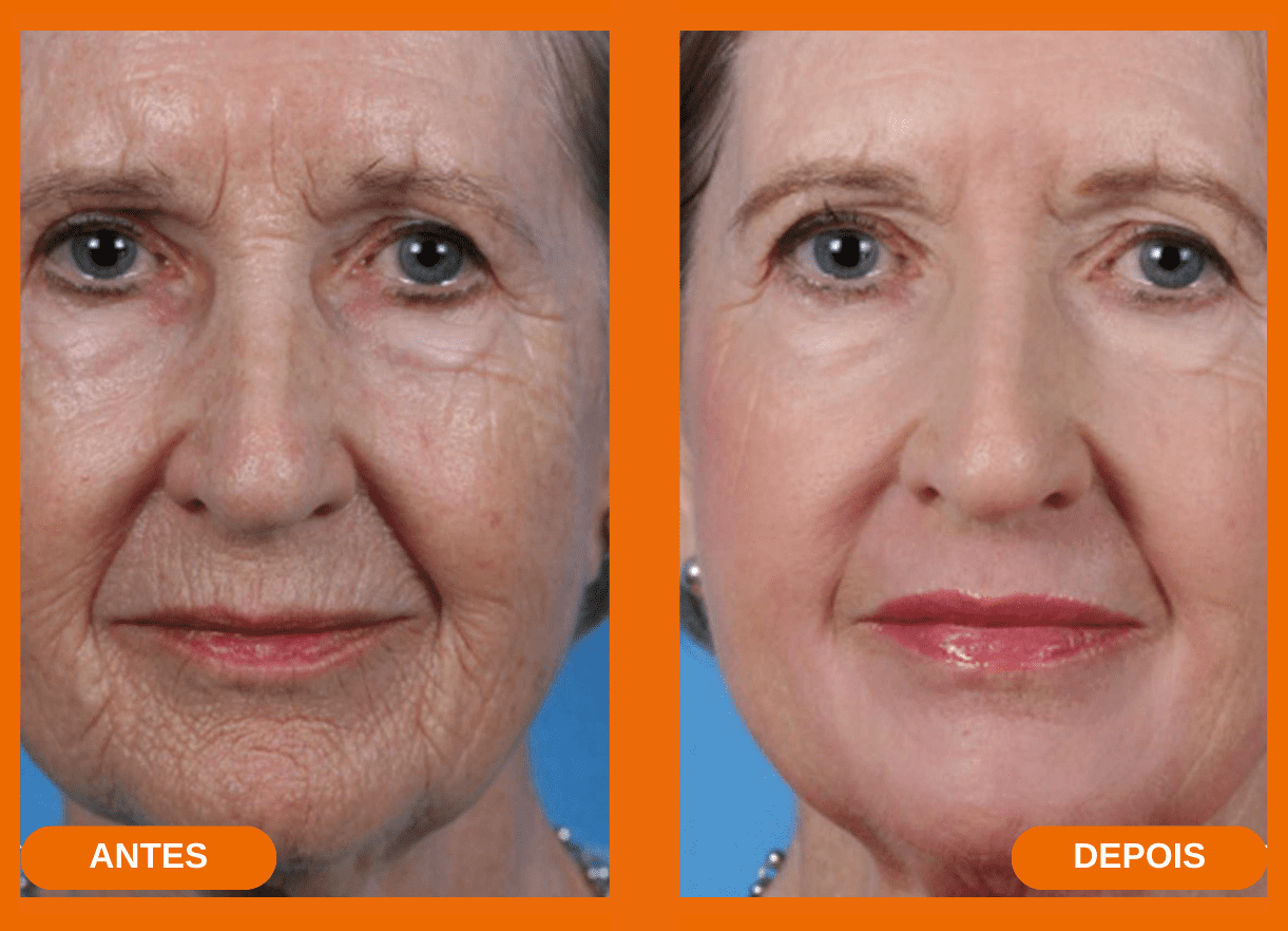 Antes e Depois 1.1 (1)